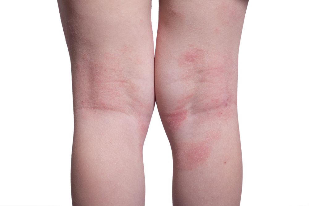 Remédio caseiro para Eczema 4 Eczema
