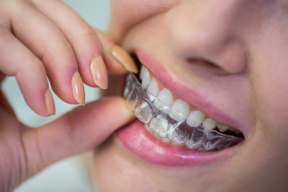 Como deixar os dentes retos? 4 deixar os dentes retos