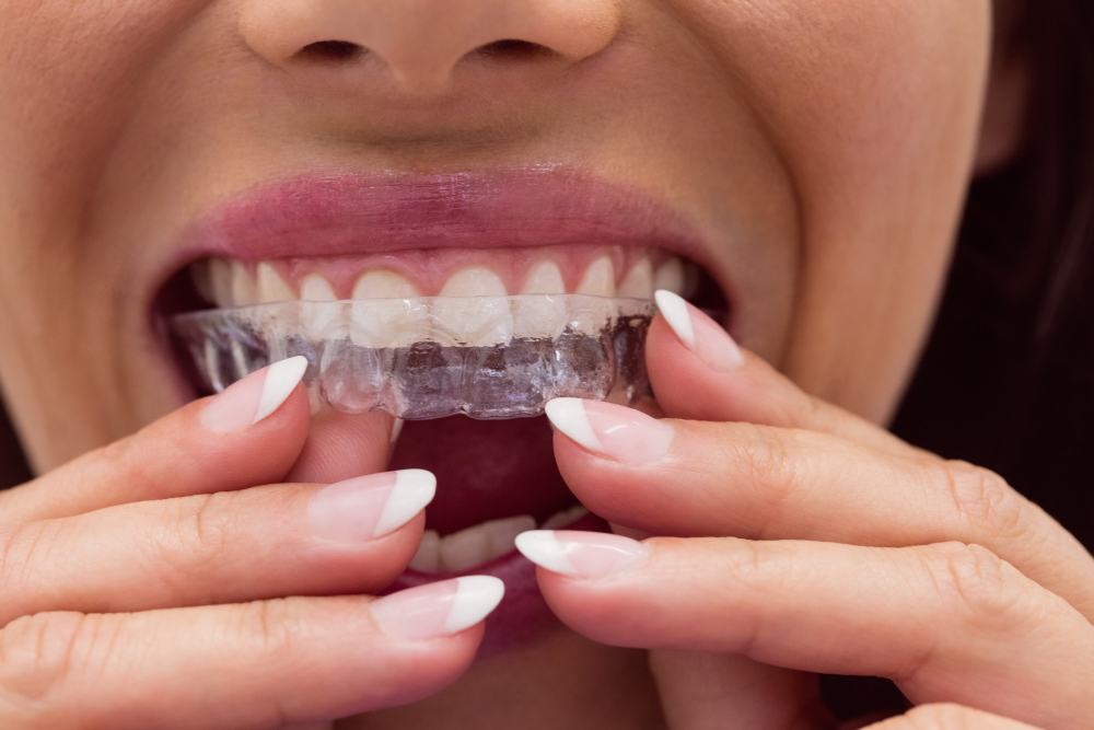 Como deixar os dentes retos? 5 Aparelho transparente